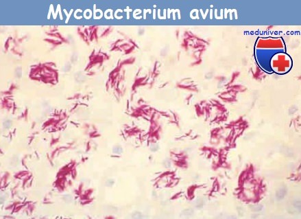  Mycobacterium avium