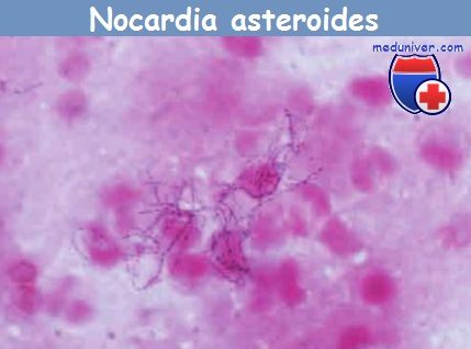   - Nocardia asteroides