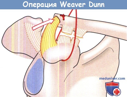  Weaver Dunn  - 