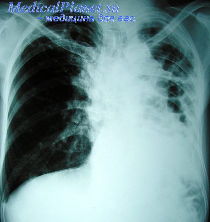 детский туберкулез
