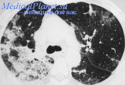Компьютерная томография при эозинофильной пневмонии