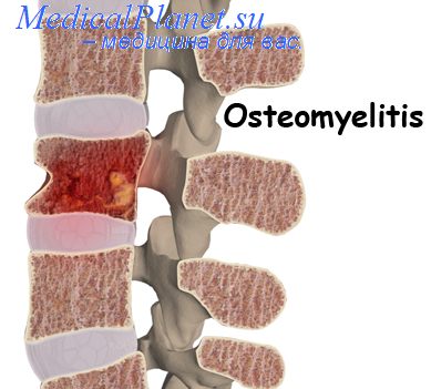 негематогенный остеомиелит