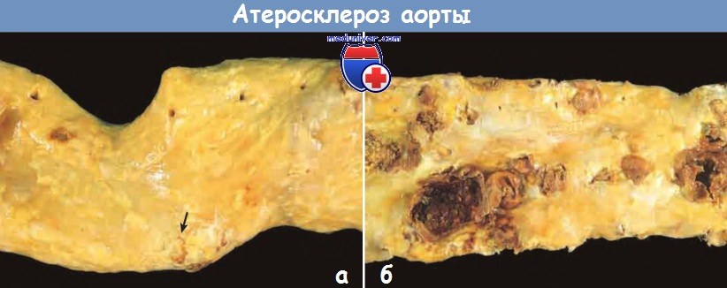 Атеросклероз аорты