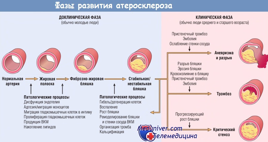 Фазы развития атеросклероза