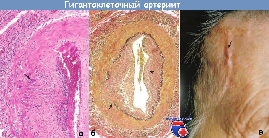 Гигантоклеточный артериит