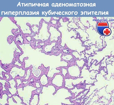 Атипичная аденоматозная гиперплазия кубического эпителия