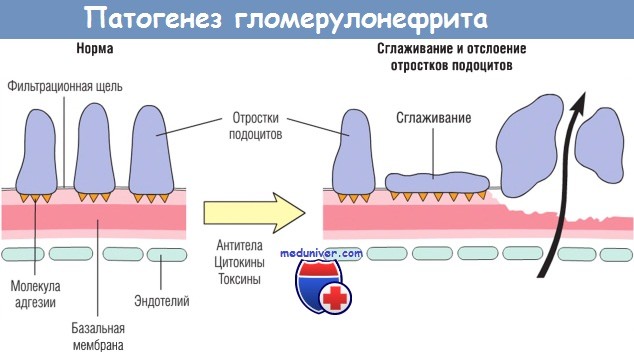 Гистология гломерулонефрита