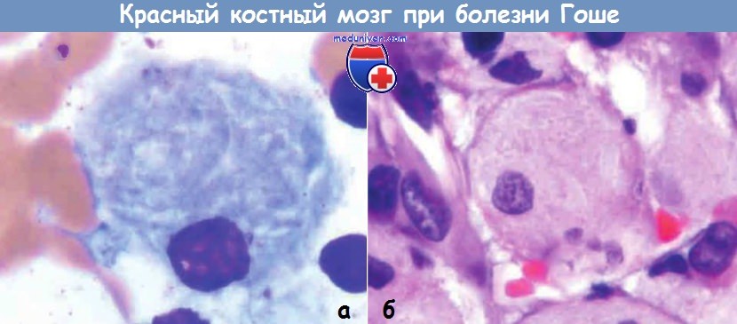 Красный костный мозг при болезни Гоше