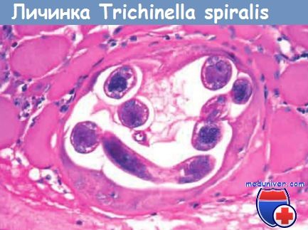   - Trichinella spiralis
