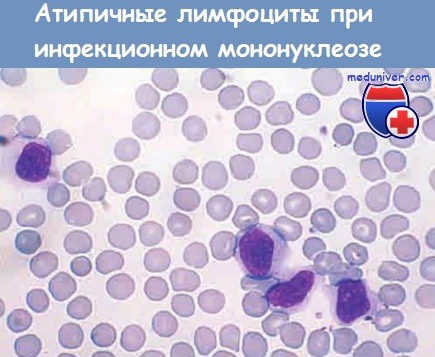 Атипичные лимфоциты при инфекционном мононуклеозе