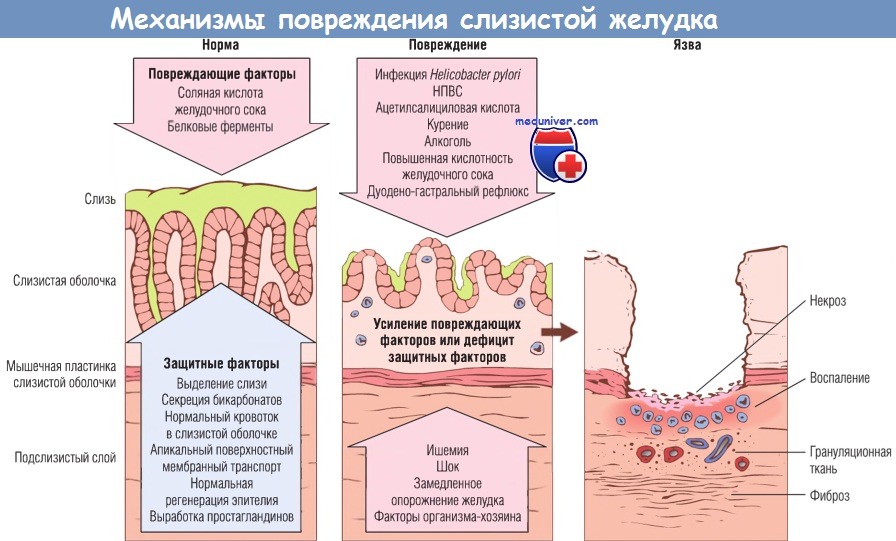 Механизмы развития гастрита - патогенез