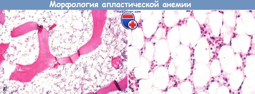 Звенья патогенеза апластической анемии thumbnail