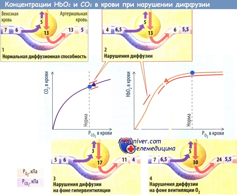 Концентрация HbO2 и СО2 при нарушении диффузии газов