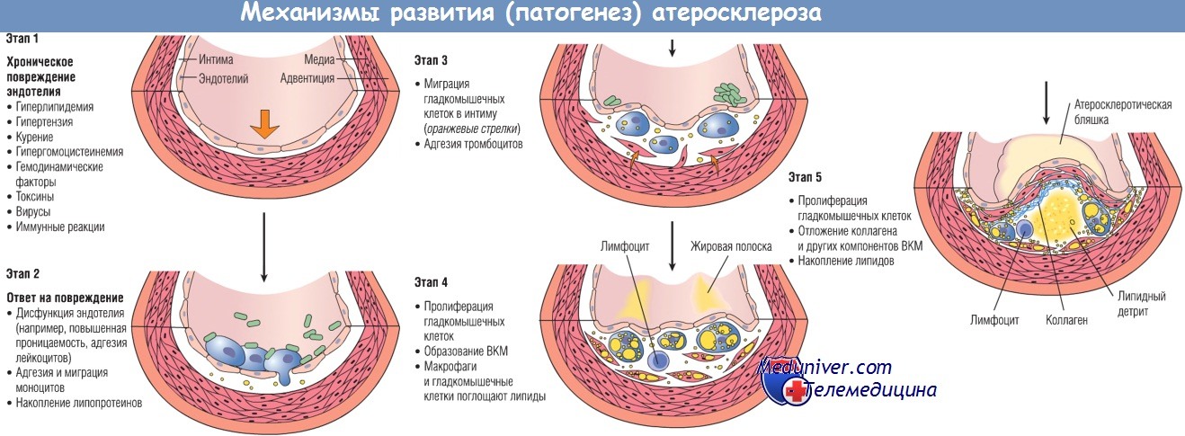 Механизмы развития (патогенез) атеросклероза
