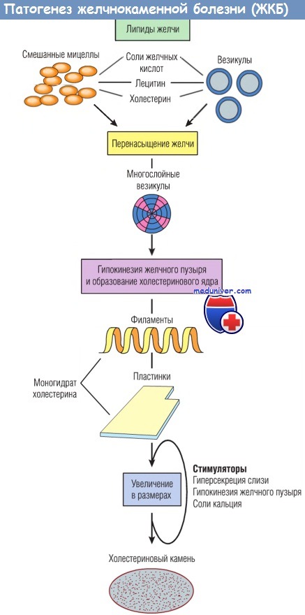Патогенез желчнокаменной болезни - холелитиаза