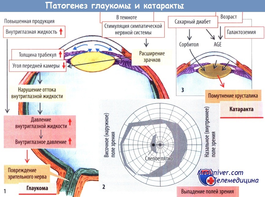 Классификация глаукомы. Закрытоугольная глаукома этиология. Патогенез закрытоугольной глаукомы. Патогенез первичной открытоугольной глаукомы. Схема оттока внутриглазной жидкости.