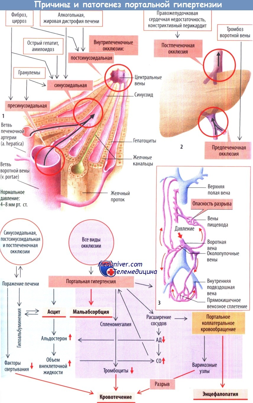 Причины и патогенез портальной гипертензии