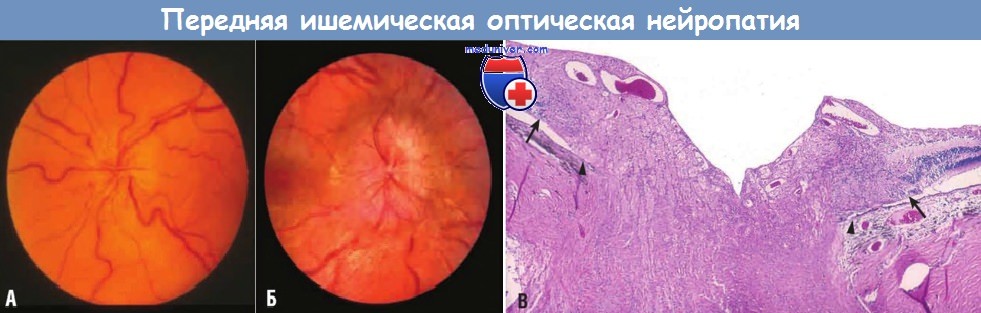 Передняя ишемическая нейропатия. Передняя ишемическая нейропатия зрительного. Нейрооптикопатия зрительного нерва. Ишемическая нейропатия глаза. Ишемическая нейрооптикопатия глаза.