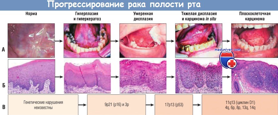 Прогрессирование рака полости рта