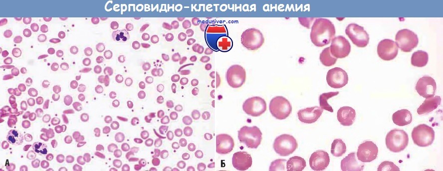 Патогенез серповидно-клеточной анемии