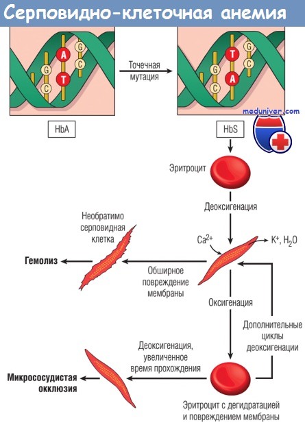 Механизм развития серповидноклеточной анемии thumbnail
