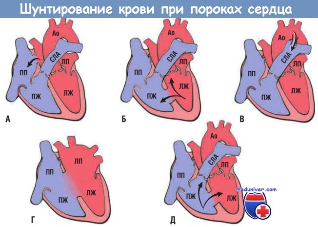 Шунтирование крови при пороках сердца