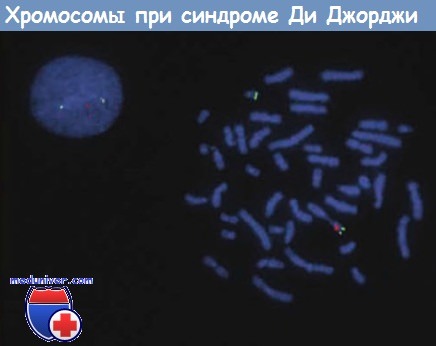 Хромосомы при синдроме Ди Джорджи
