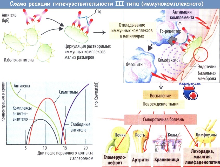Схема аллергии третьего типа - иммунокомплексной гиперчувствительности