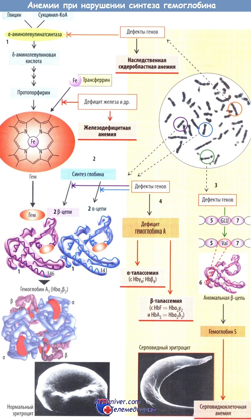 Схема анемии при нарушении синтеза гемоглобина