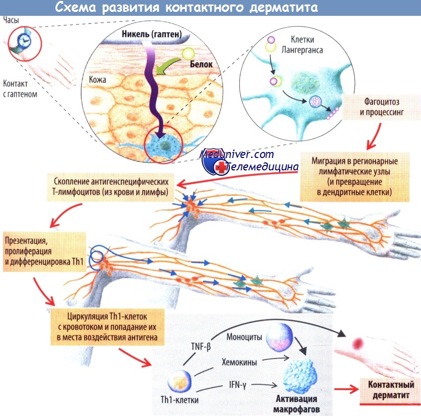 Схема патогенеза контактного дерматита