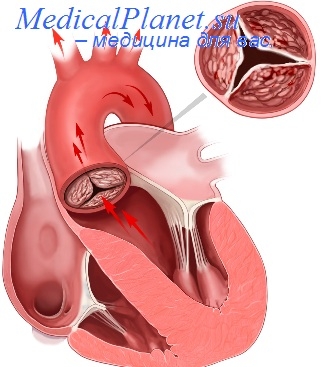 аортальный стеноз