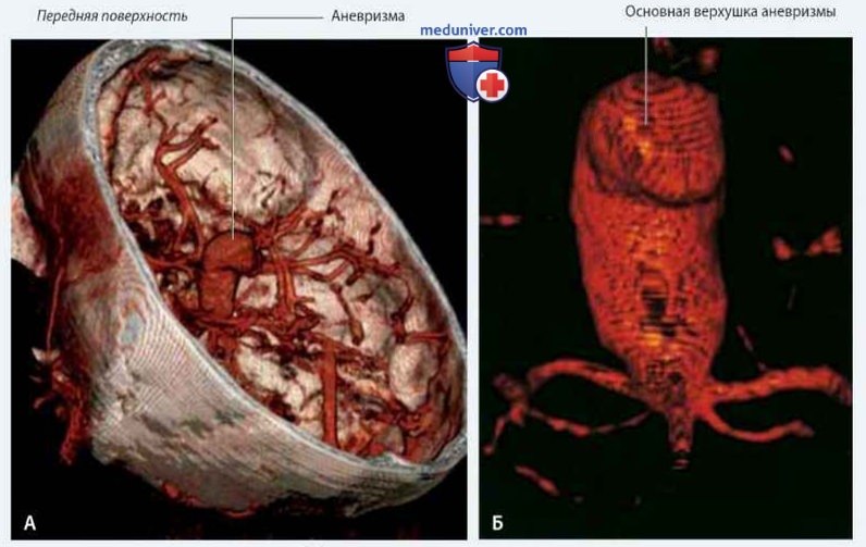 Кровоснабжение головного мозга: анатомия, топография