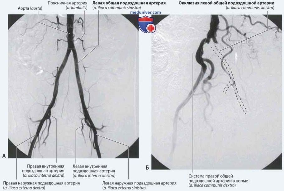 Окклюзия левой общей подвздошной артерии: клинический случай