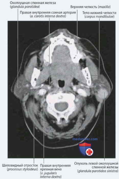 Околоушная железа (glandula parotidea): анатомия, топография