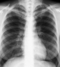 рентгенография сердца