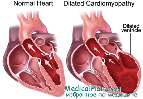 дилятационная кардиомиопатия