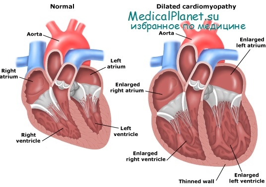 дилятационная кардиомиопатия
