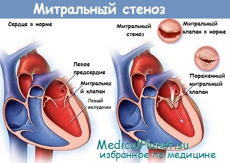 Митральный стеноз, или стеноз митрального клапана