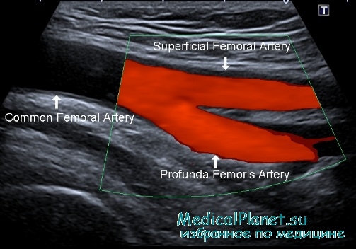 стенозирующие болезни артерий нижних конечностей