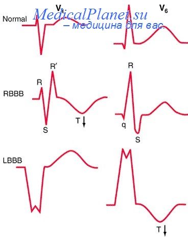 Диагностика инфаркта при кардиостимуляторе thumbnail
