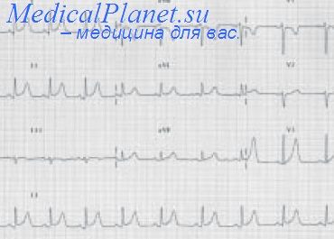 острая фаза инфаркта миокарда