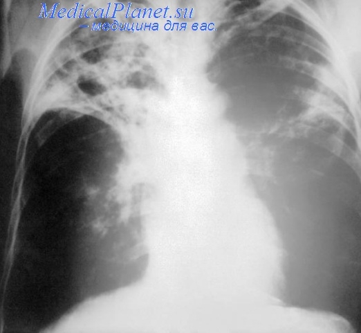 туберкулез при пороке сердца