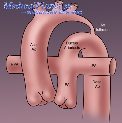стеноз легочной артерии