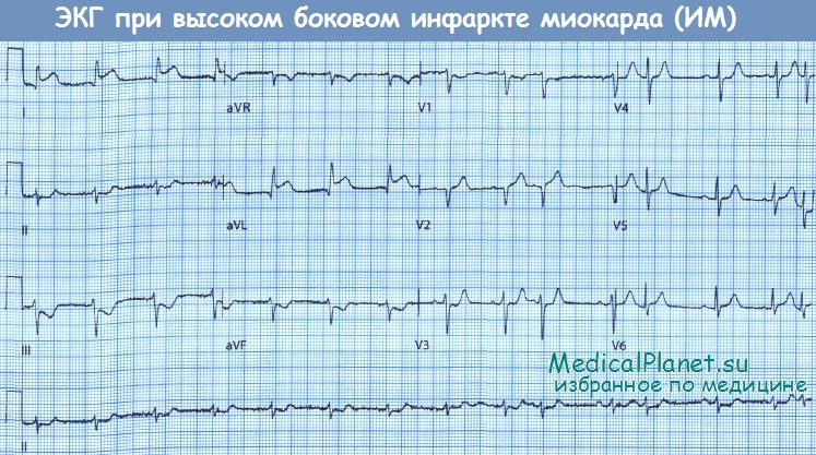 Боковой инфаркт миокарда - ЭКГ