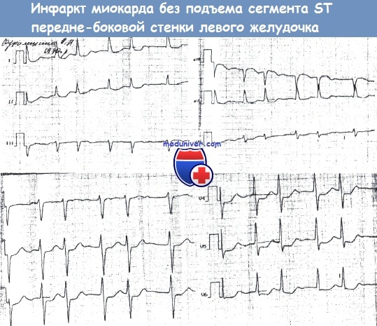 Инфаркт миокарда без подъема сегмента ST на ЭКГ
