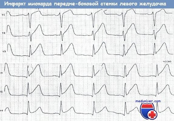 Инфаркт миокарда передне-боковой стенки левого желудочка