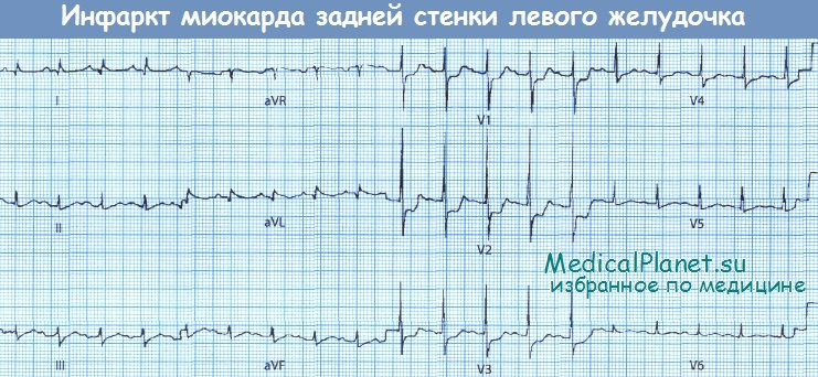Инфаркт миокарда задней стенки левого желудочка - ЭКГ