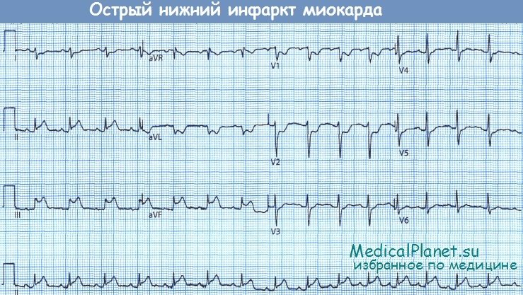 Нижний инфаркт миокарда - ЭКГ