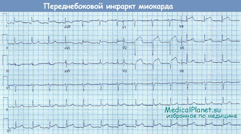 Переднебоковой инфаркт миокарда - ЭКГ