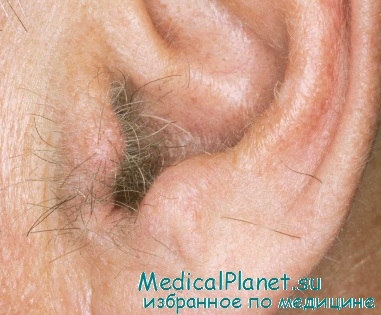 волосатое ухо при атеросклерозе